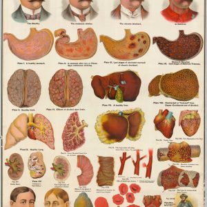 Hardacre's Temperance Map Illustrating The Effect of Alcoholic Drinks and Narcotics on the Human System.